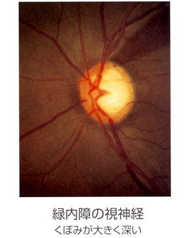 緑内障の視神経